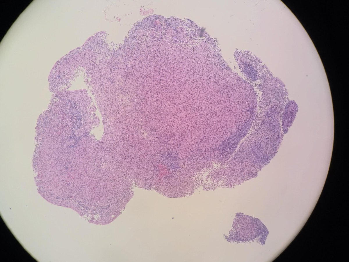 fetot's tweet photo. Monday, monday! Bladder biopsy with malakoplakia - the pathognomonic finding of MG (Michaelis Gutman) bodies were easily found on H&amp;E and confirmed by the von kossa stain. https://t.co/wdMD869jpC