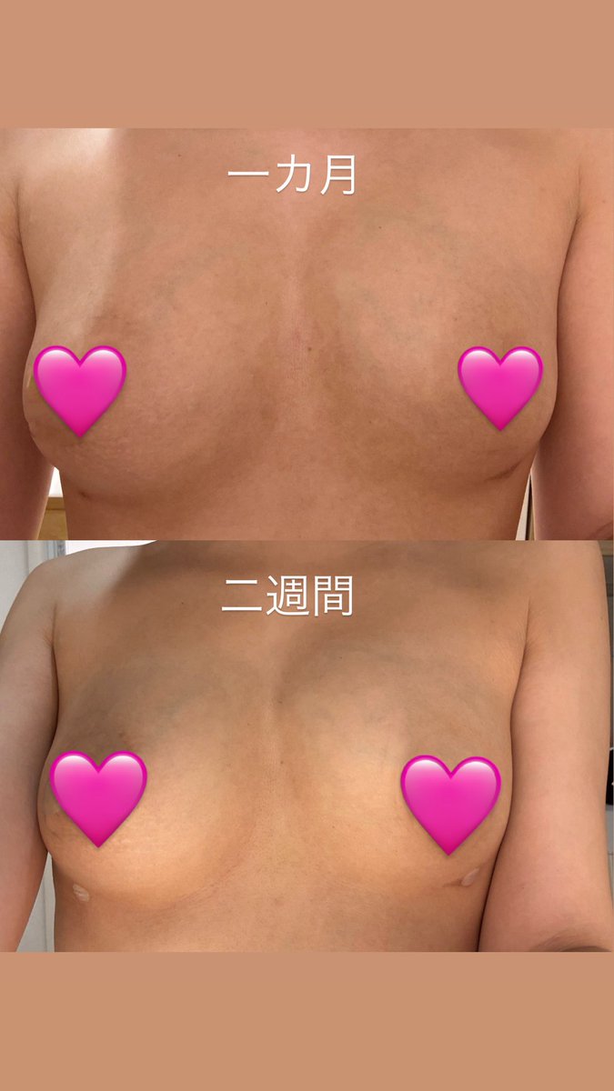 biyouonnidesu's tweet photo. 太もも脂肪吸引、脂肪豊胸してから１ヶ月たった‼️1ヶ月までほんとにしんどかったけどやっと足も普通にもどってきた‼️
浮腫もまだ膝に溜まるけど細くなってきた〜😆胸も脂肪ちゃんとあるよ‼️

@READYPS_JP https://t.co/GcAXkyQFiu