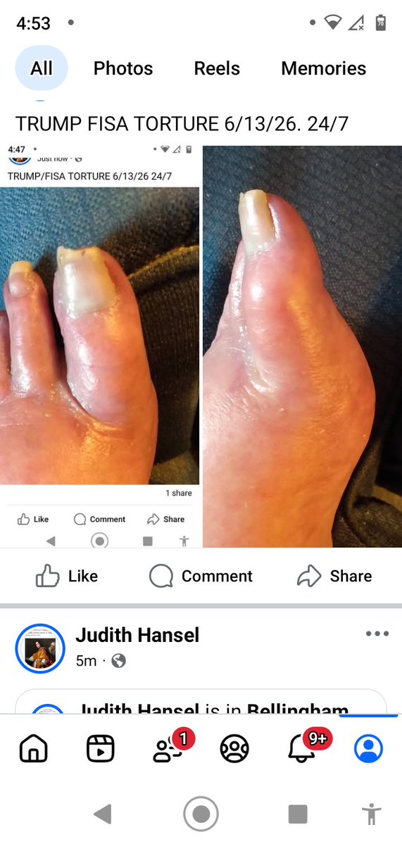 JudithHansel1's tweet photo. @Countrygrl_mk Daily nerve pain. Unable to walk. Peroneal nerve attacked. Implant draining 
Nanobots https://t.co/qRrirKKLJy