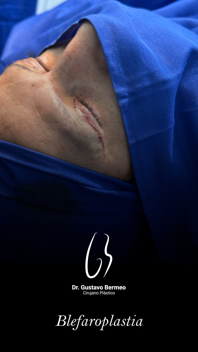 gusber1985's tweet photo. La blefaroplastia permite renovar la expresión con precisión y sutileza, logrando una apariencia más fresca, descansada y naturalmente elegante. https://t.co/e09gus2vhl