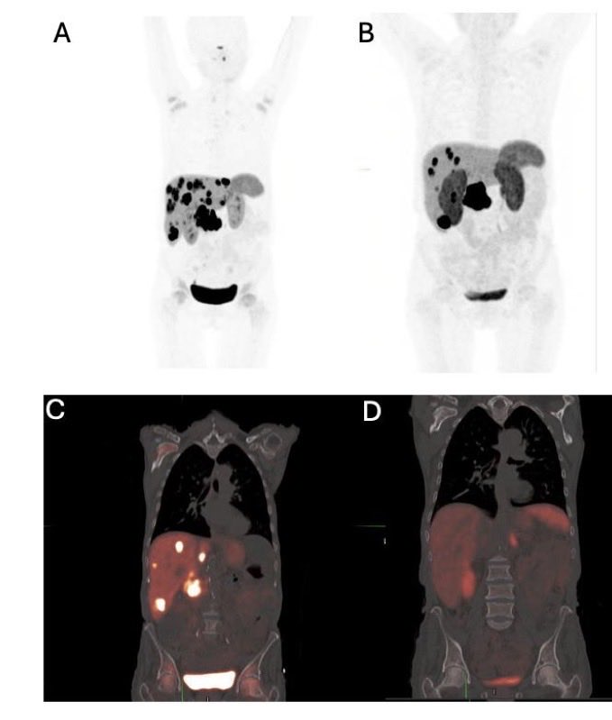 UGrewalMD's tweet photo. Happy to share in print @OncJournal - Robust response to Pembrolizumab in a patient with metastatic VIPoma with acquired TMB-high/MSI-high phenotype post treatment with temozolomide. 
Bottom line- in a patient with pancreatic or lung NET post exposure to temozolomide: always check liquid biopsy (or tissue if possible) and test for a hypermutated phenotype. In the presence of MSI-H disease or co-occurring DDR alterations, response to ICI can be durable and robust. 

Kudos to @CShi321 @EmoryUniversity and my colleagues @PoHienEar @SethConcorsMD and others for helping put this together. @WinshipAtEmory @TheGutOncLab 

https://t.co/kjzHTn6uPy