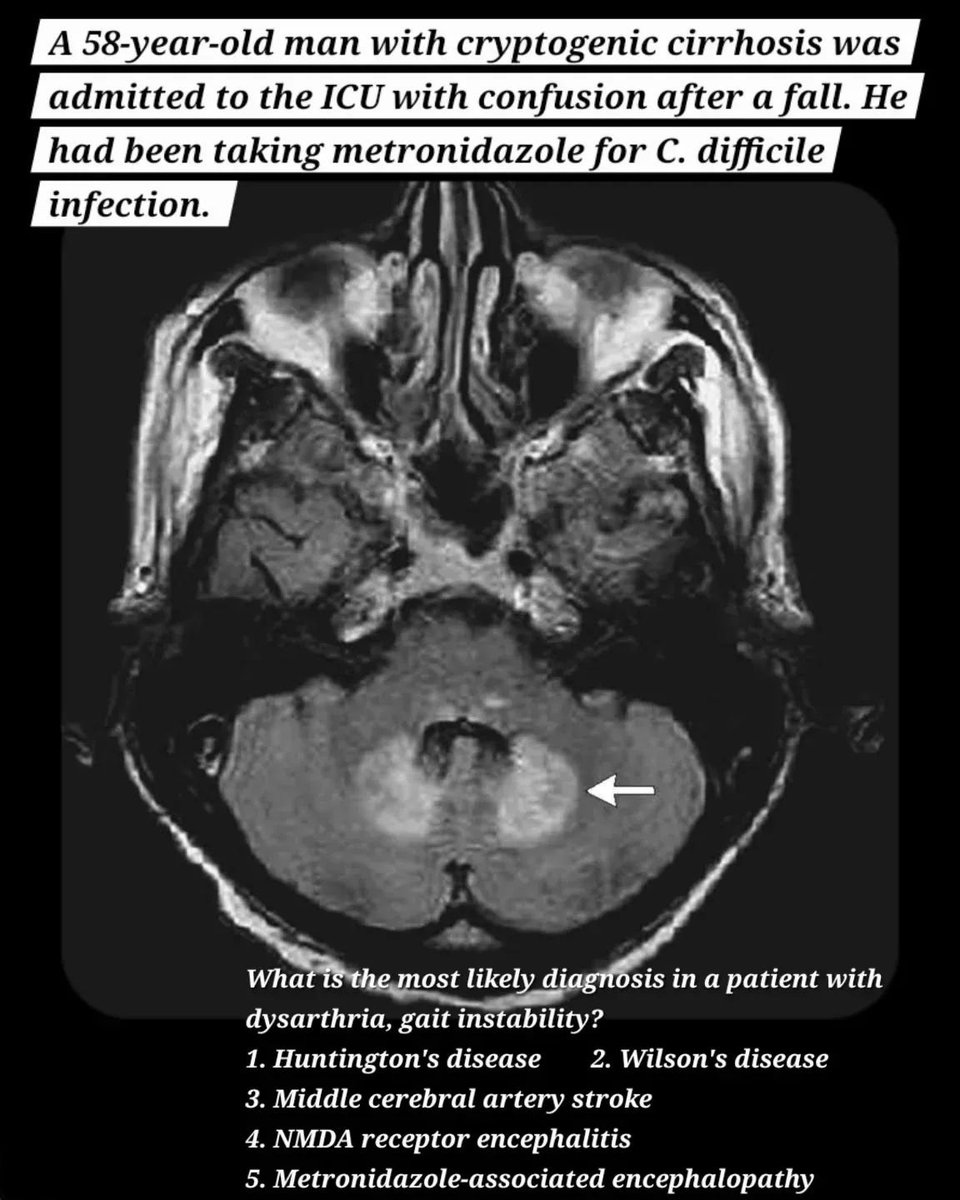 albertoortegana's tweet photo. What is the most likely diagnosis in a patient with dysarthria, gait instability, and this MRI finding?
#Neurology #Neuroradiology #BrainMRI https://t.co/FqwGX8xW9d
