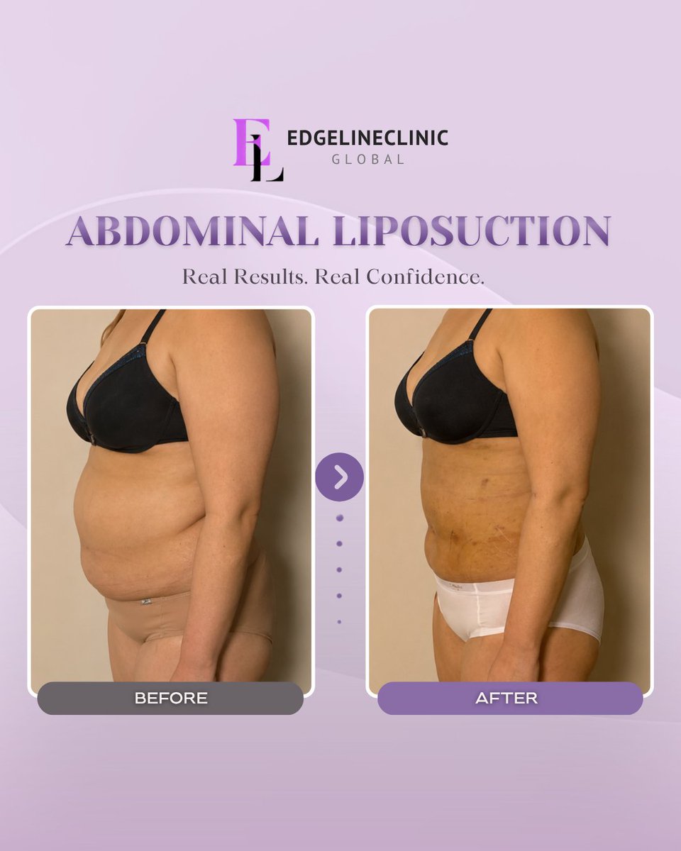 edgeline_global's tweet photo. Not me zooming in on the waistline…

📩 Book your consultation today.
WhatsApp: +82 10 3970 2135
Email: edgelinegangnam@naver.com
WeChat: edgeline_gangnam
LINE: @343tnxkn

#abdominalliposuction #korealiposuction #koreaplasticsurgery #beforeandafter #plasticsurgery #liposuction https://t.co/EUY8LTcKpK