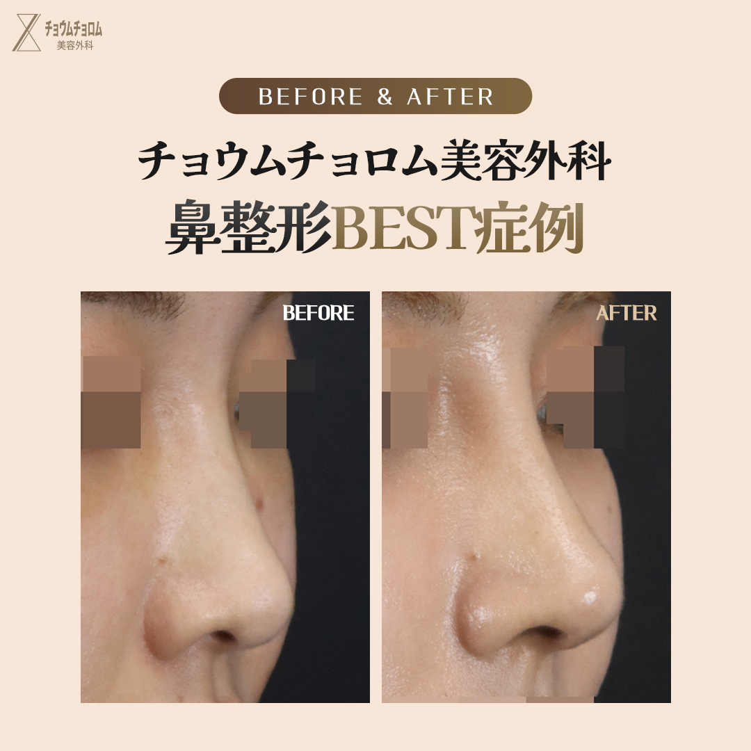 likefirst_jp's tweet photo. チョウムチョロムが教える
#整形手術 Before&After

目、鼻手術はすべて自信あります。
チョウムチョロム美容外科では’工場式’のような画一的な手術は行いません。
患者の目、鼻の形と年齢、シーズンなどの状態に合わせて
1：1パーソナライズで安全に手術を行う事をお約束します。
カウンセリングから手術、後管理まで代表院長1：1責任制で全ての過程を担当し、
嘘のない診療を行います。

#チョウムチョロム美容整形外科　#目整形　#鼻整形
#代表院長パーソナライズカウンセリング無料
#江南駅

#チョウムチョロム美容整形外科 #鼻整形 #小鼻縮小 #ナチュラル #鼻整形 #鼻再手術 #拘縮鼻 #韓国整形 #鼻中隔延長 #鼻鏧形レポ #鼻先 #鼻形 #美容整形 #形 #軟骨移植 #鼻整形レビュー #プチ軽形 #中年整形 #美意識 #美容オタク #美容整形外科 #形メイク #鼻尖形成 #軟骨移植 #鼻整形レポ #整形レポ #美容整形 #美容外科 #美容整形外科 #韓国ビューティー