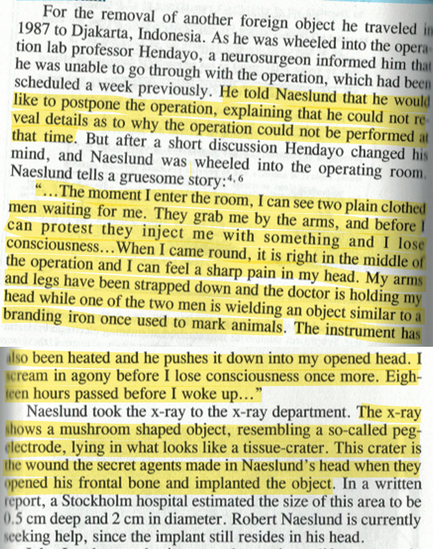 toxictiramisu's tweet photo. Robert Naeslund was implanted w/ a bio-telemetric device in a Swedish hospital. After an altercation w/ police, he was put to sleep w/o consent &amp; awoke to a strange radio-like sound in his head. X-rays revealed foreign objects in his brain, causing memory loss/behavioral changes. https://t.co/rcPcJzHUNn