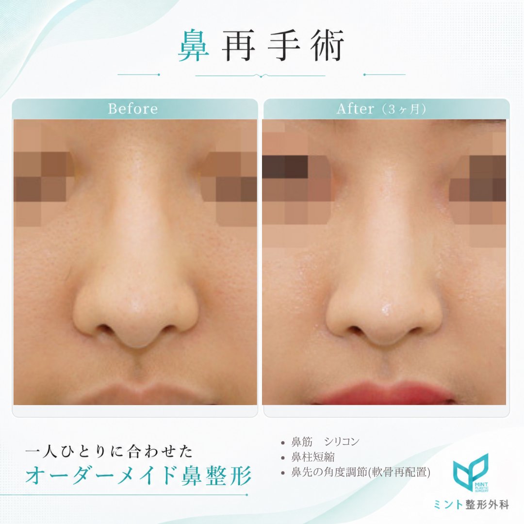 mintpskr's tweet photo. 🍀ミント整形外科🍀

👃鼻再手術

✔鼻筋　シリコンプロテーゼ
✔鼻柱短縮
✔鼻先の角度調節（軟骨再配置）

鼻柱の下垂した部分が自然にキレイに🩵
斜めから見た鼻もスッキリしました✨

＃カンナム整形外科　＃鼻フル　＃渡韓整形
＃自然な鼻　＃垢抜け　＃鼻再手術 https://t.co/bIyFkgnHgT