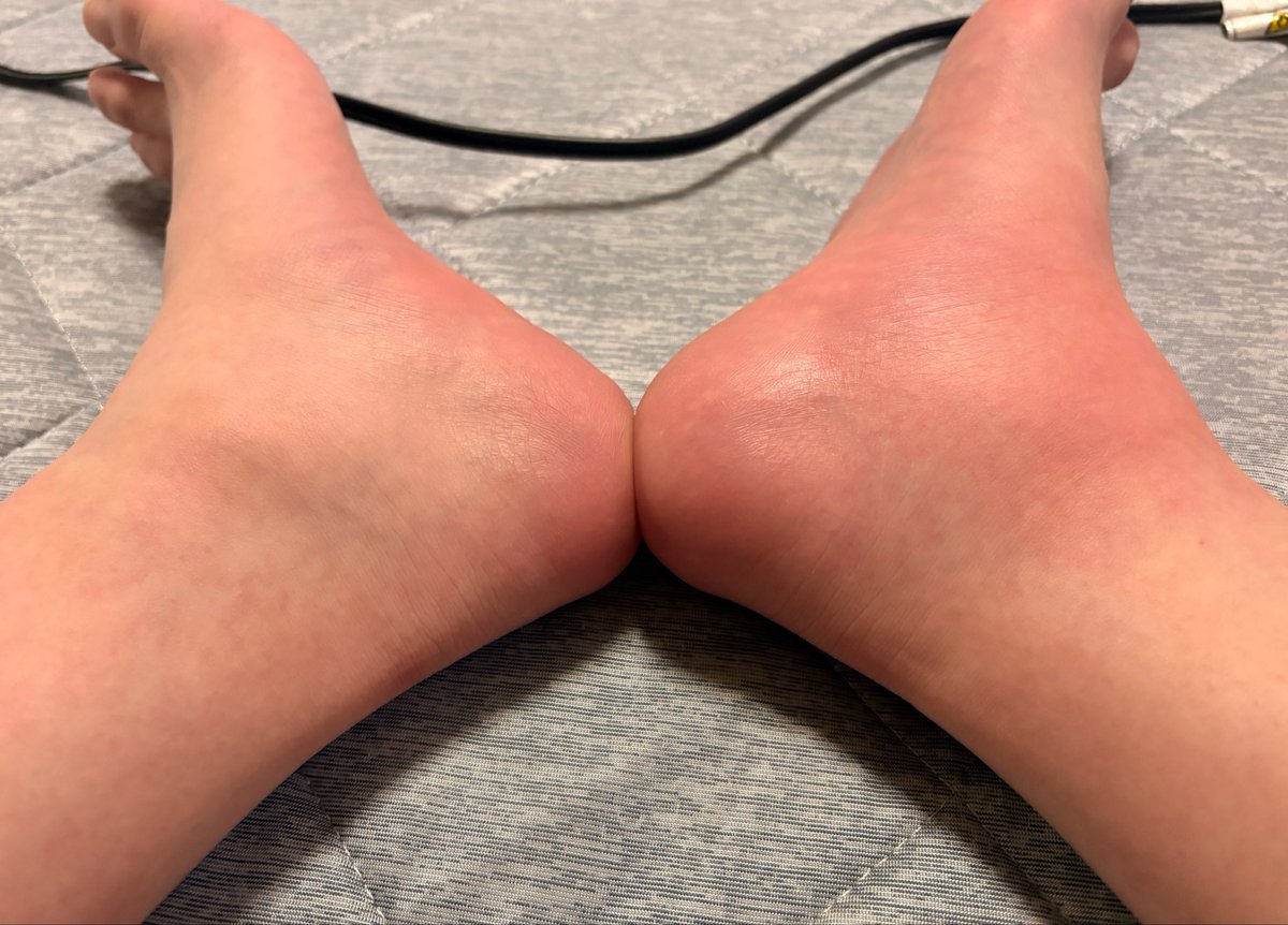 0tmnl's tweet photo. なんか腫れてる
写真だとあんまわかんないな https://t.co/INj9znlVvQ