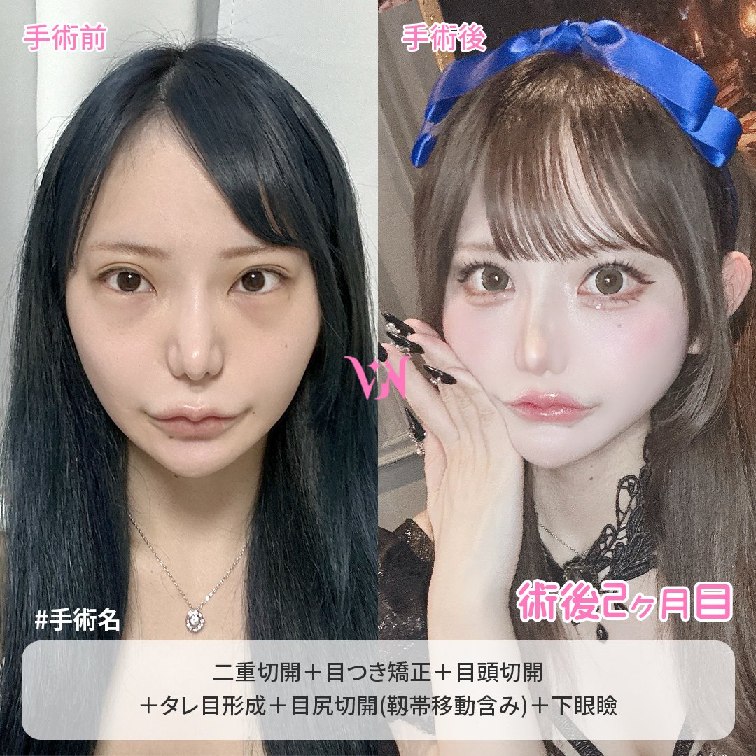 vannypsjp's tweet photo. 💖バンニ美容外科　症例写真💖

🔸手術内容🔸
【目】 二重切開(再手術)＋目つき矯正＋目頭切開＋目尻切開(靱帯移動含み)＋タレ目形成(＝目下切開)＋下眼瞼

『二重切開＋目つき矯正』 → 左右差を改善し、くっきりした目元に
『目頭切開』 → 下がって見える目頭を横に広げ、バランスよく改善
『目尻切開＋タレ目形成』 → つり目をしっかり改善し、目全体のサイズもアップ
『下眼瞼』 → 目の下のたるみやクマすっきり改善

お問い合わせや施術予約は公式LINEまで💌
https://t.co/4O2j3YLgFq 

ホームページ 
https://t.co/g33AhhBrw4

#韓国整形 #二重整形 #二重再手術 #自然癒着 #二重切開 #目つき矯正 #眼瞼下垂 #目上切開 #目頭切開 #目尻切開 #タレ目切開 #目下切開 #額挙上 #鼻整形 #鼻再手術 #鼻筋 #鼻先 #団子鼻矯正 #鷲鼻矯正 #低い鼻矯正 #長い鼻矯正 #短い鼻矯正 #鼻唇角矯正 #小鼻縮小 #機能鼻手術 #下鼻甲介 #鼻中隔湾曲症 #クリニック