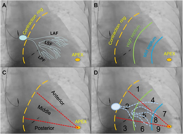 jacabreracardio's tweet photo. Anatomical considerations for left bundle branch area pacing - Heart Rhythm https://t.co/cledrvwHnq  @CardioQuironMad @cardiac_anatomy https://t.co/dXJ2wizNjv
