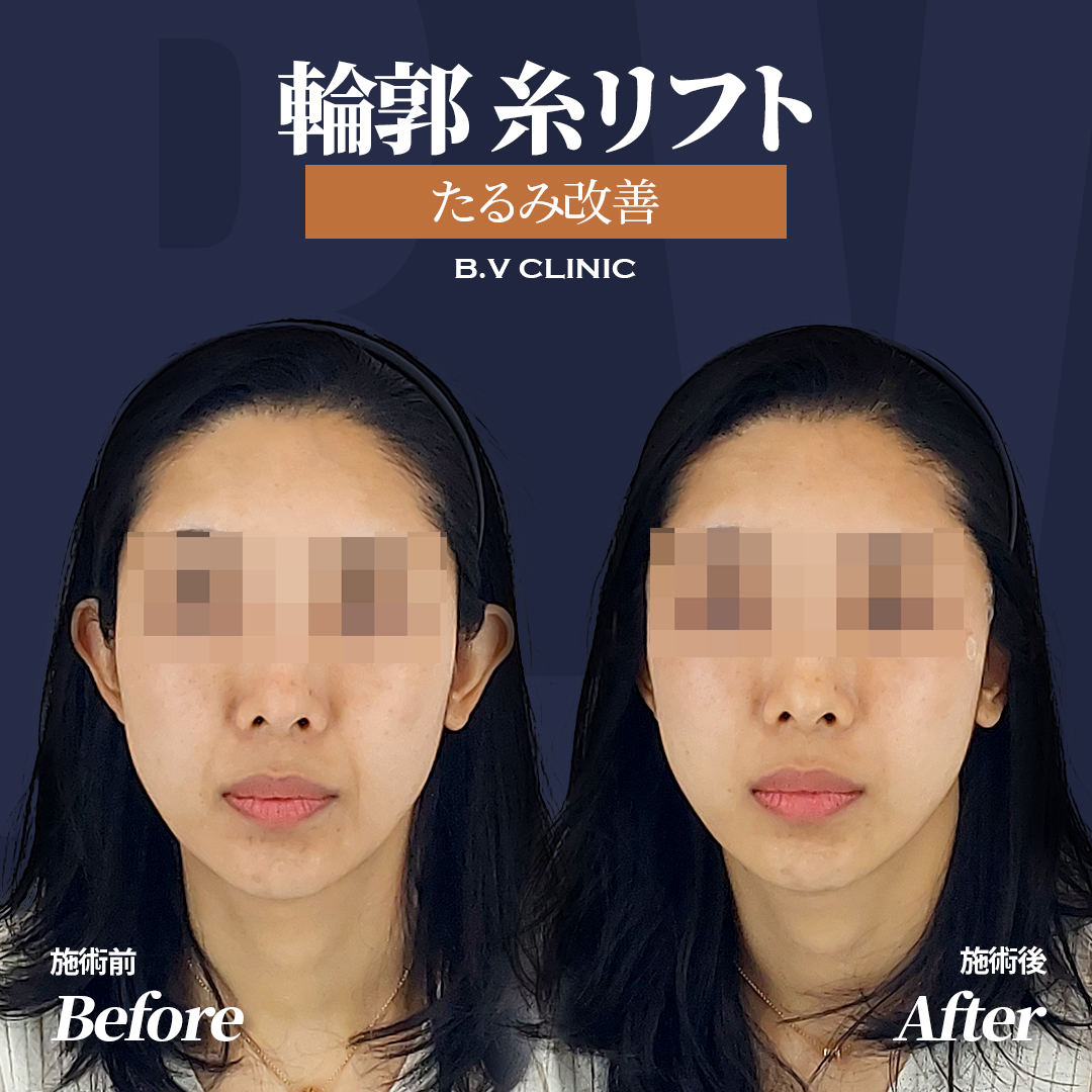 BVclinicjp's tweet photo. ほうれい線やフェイスラインのお悩み、
年齢だけが原因ではありません🥺

20代・30代でも、
ほうれい線や輪郭のもたつきが
気になり始めることがあります😊

理想の輪郭を手に入れましょう💖

韓国糸リフトはBV💙
お問い合わせはこちら!     
https://t.co/f2nIlfa6ht 

#カンナム #渡韓美容 #渡韓情報 https://t.co/09ZJvpCzhQ
