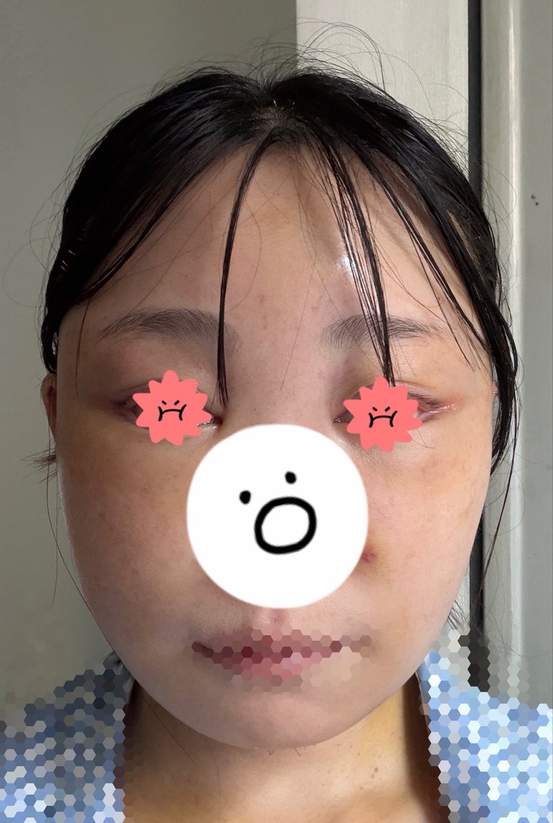 chi3a_oxo's tweet photo. 6日目
やっぱり朝が1番スッキリしてる。
涙袋もうっすら出てきた。でも下膨れは全開。顔のジンジンも薄れてきたけど、おでこは相変わらずテカテカしてる。
明日帰国だけど大丈夫かなぁ…とりあえずいっぱい歩かなきゃだから観光しよ。固いの食べれないし、指2本分しか口開かないけど食欲はめっちゃある https://t.co/lB0Xmwhun0