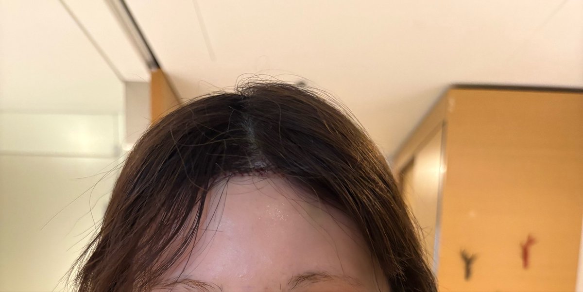 nyanmania2's tweet photo. スタート整形外科で額縮小やってきたんだけど直後から効果出ててやばい笑
1.3cm短くしてもらったよん

1枚目before、2枚目術直後

@startplasty 
#額縮小 https://t.co/CR7oZLTfMq