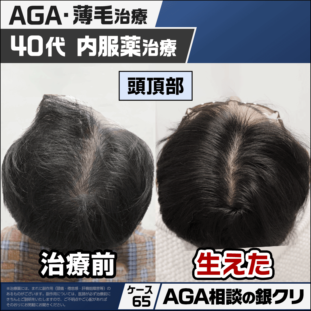 gincli_aga's tweet photo. 【銀クリのAGA相談室 92】
Q.生え際も頭頂部も薄くなっているけど改善できる？

生え際・頭頂部の両方が進行している
場合でも、薄毛の進行状況に応じた治療
によって改善がみられます。

AGAの進行パターンには
・生え際から進行するM型
・頭頂部が薄くなるO型
・前頭部から頭頂部にかけて進行するU型
などがあります。

治療を行う際には経過を写真で
残していきますが、進行部位によって
その見え方は異なりますので撮影の際には
一つの画角だけでなく複数の画角で
撮影し評価することが重要です。

今回ご紹介する40代男性は初診時に
前頭部から頭頂部にかけて
軟毛化が見られ、進行度としては
ハミルトン・ノーウッドⅡvertex型 
と診断されました。

内服薬治療に加え、毛乳頭細胞の活性化を
目的に銀クリLEDセラピーを並行で実施。
LEDセラピーは月に毎月1回・15分の照射を
計6回行いました。

治療開始から約3ヶ月で毛髪の硬毛化が
みられ、LEDセラピーを計6回行った頃には
毛髪密度の改善が認められました。
現在は内服薬のみで治療を継続しています。

今回はこちらの患者様のお写真を
生え際と頭頂部2つの画角から
確認できるよう紹介いたします。
それぞれの部位の変化を
見比べてご覧ください。

※治療効果には個人差があります。

▼「自分に近い症例はある？」
気になる方は、リプライをご覧ください。