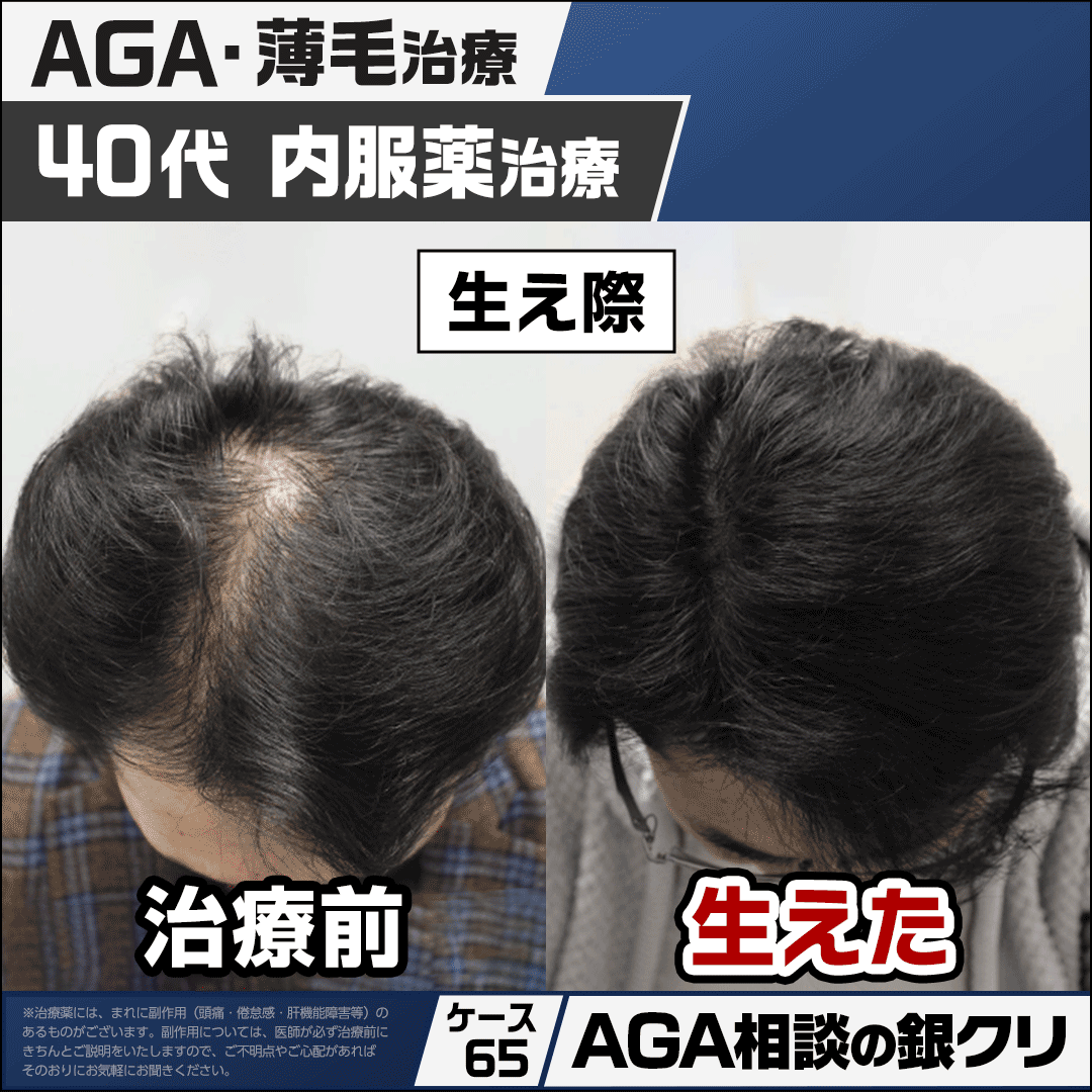 gincli_aga's tweet photo. 【銀クリのAGA相談室 92】
Q.生え際も頭頂部も薄くなっているけど改善できる？

生え際・頭頂部の両方が進行している
場合でも、薄毛の進行状況に応じた治療
によって改善がみられます。

AGAの進行パターンには
・生え際から進行するM型
・頭頂部が薄くなるO型
・前頭部から頭頂部にかけて進行するU型
などがあります。

治療を行う際には経過を写真で
残していきますが、進行部位によって
その見え方は異なりますので撮影の際には
一つの画角だけでなく複数の画角で
撮影し評価することが重要です。

今回ご紹介する40代男性は初診時に
前頭部から頭頂部にかけて
軟毛化が見られ、進行度としては
ハミルトン・ノーウッドⅡvertex型 
と診断されました。

内服薬治療に加え、毛乳頭細胞の活性化を
目的に銀クリLEDセラピーを並行で実施。
LEDセラピーは月に毎月1回・15分の照射を
計6回行いました。

治療開始から約3ヶ月で毛髪の硬毛化が
みられ、LEDセラピーを計6回行った頃には
毛髪密度の改善が認められました。
現在は内服薬のみで治療を継続しています。

今回はこちらの患者様のお写真を
生え際と頭頂部2つの画角から
確認できるよう紹介いたします。
それぞれの部位の変化を
見比べてご覧ください。

※治療効果には個人差があります。

▼「自分に近い症例はある？」
気になる方は、リプライをご覧ください。