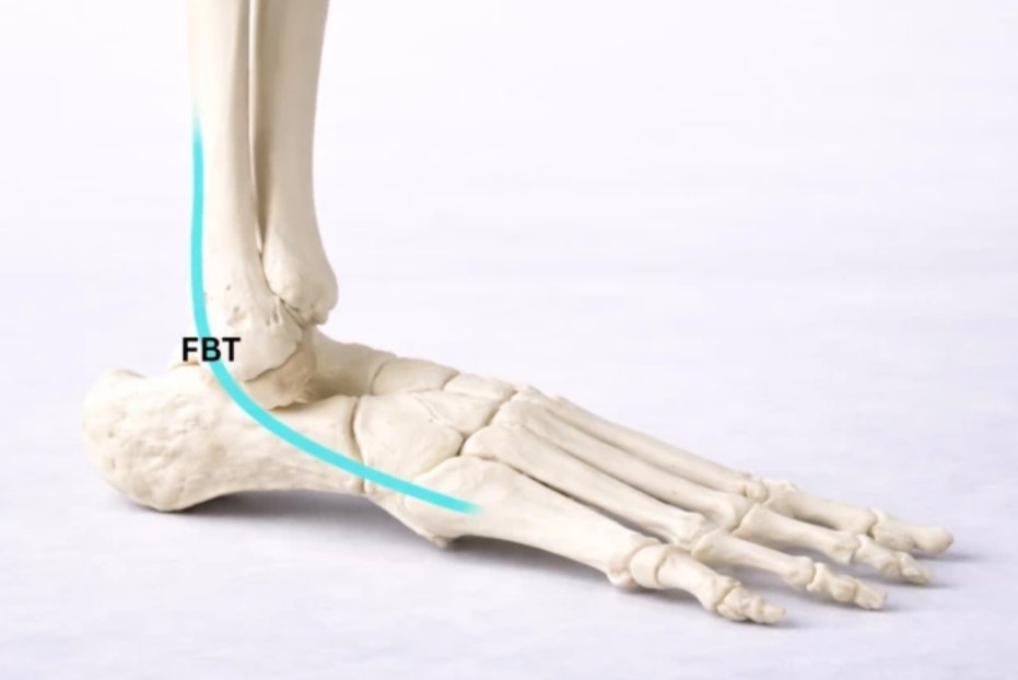 Rheumatology's tweet photo. Fibularis brevis tendon variants: a classification-based surgical and radiological approach
https://t.co/axmLF2bZQX https://t.co/4IiyCMLseU