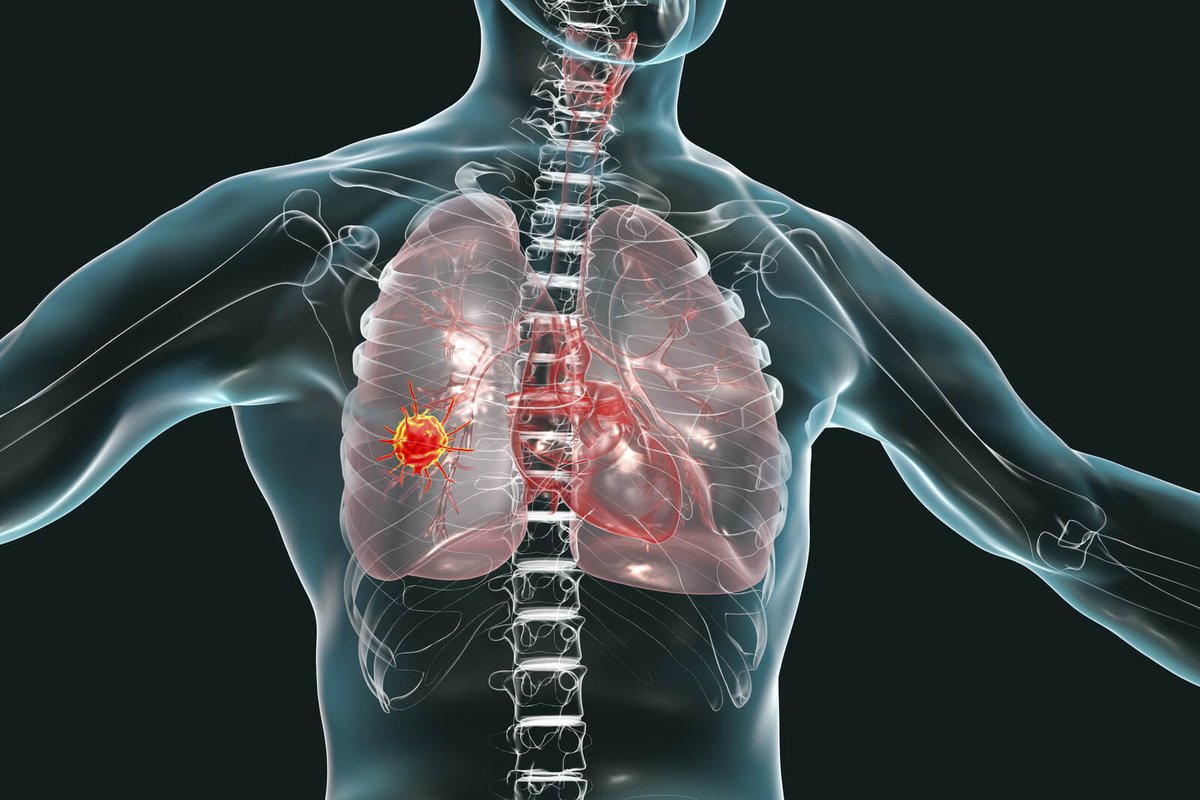 CizzlePlc's tweet photo. Inflection point for @CizzlePlc
Our CIZ1B #LungCancer blood test is now approved for clinical use in US under CLIA accreditation, marking our first commercial deployment and establishing a regulated route to market 
Read more: https://t.co/2bLqJElw38
#EarlyDetection #BioTech https://t.co/xtRCHRdBqB