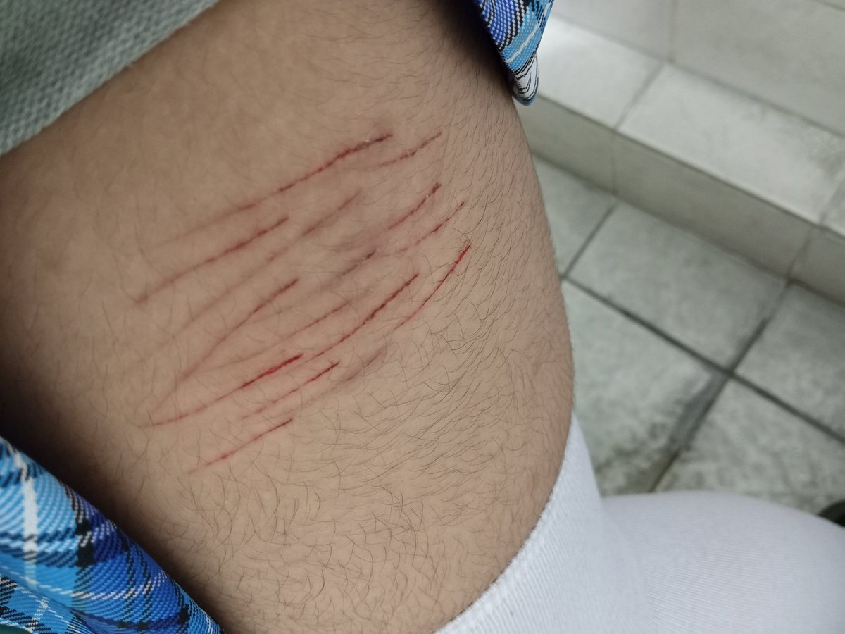 nyankonegi2's tweet photo. relapsed again earlier at school. i lowkey was iron deficiency maxxing I COULDNT STAND UP NOR WALK PROPERLY

now i gotta wait for em to heal🤷

all sfx makeup, not real
#shtwt #slittwt #slittertwitter https://t.co/fOGelvVVf8