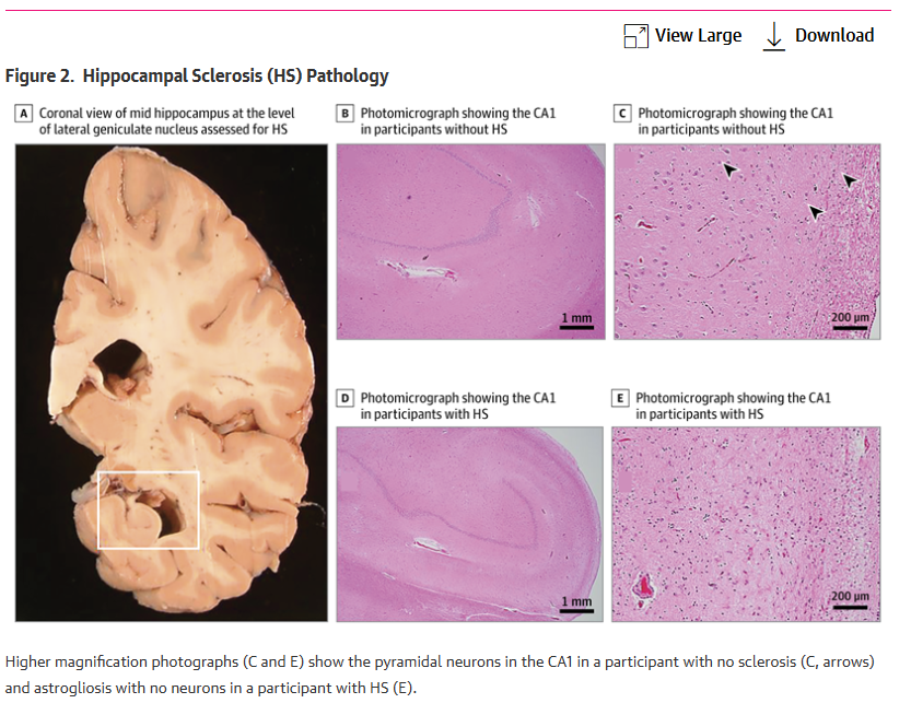 NOgymNOlimits's tweet photo. En adultos mayores, seguir una dieta MIND se asoció con menor probabilidad de esclerosis hipocampal, una lesión cerebral relacionada con demencia.

Un estudio publicado en JAMA Network Open analizó la dieta MIND: un patrón que combina dieta mediterránea y DASH, con verduras de hoja verde, frutos rojos, frutos secos, legumbres, pescado y aceite de oliva.

Fuente: Agarwal et al., JAMA Network Open, 2025.