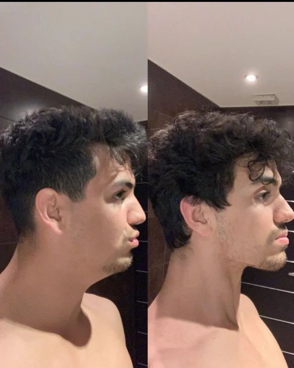 oskxra's tweet photo. La grasa facial no se puede reducir de manera localizada.

Pero esto puede ayudarte a desinflamar tu rostro:

#1 Reduce el sodio https://t.co/A893PJoRi6