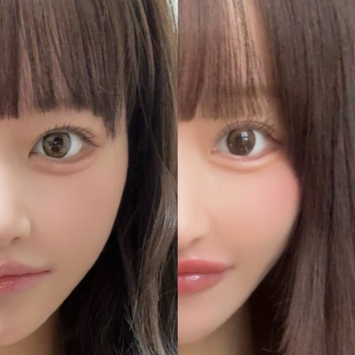 ヒット整形外科@hitpsjp で額挙上+額縮小+皺眉筋切除+側頭固定をして2週間💓
目の印象がめちゃくちゃ変わってほんとうにやってよかった😭眉毛動かしても額に一切シワが出来ないのもいい😻✌️
瞼が内出血で若干黄色いのと、額〜頭皮はまだ感覚ないです!気長に待ちます☺️ https://t.co/WleDCwFa1Z