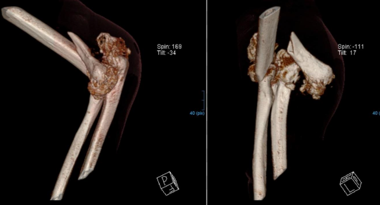 jbjs's tweet photo. "Open Reduction and Internal Fixation of a Distal Humerus Fracture Through an Elbow Pseudoarticulation After Untreated Pediatric Dislocation" by Schmid et al.
Read the full article π https://t.co/dBv3J9OHyb
#JBJS https://t.co/yudpBTWBHi