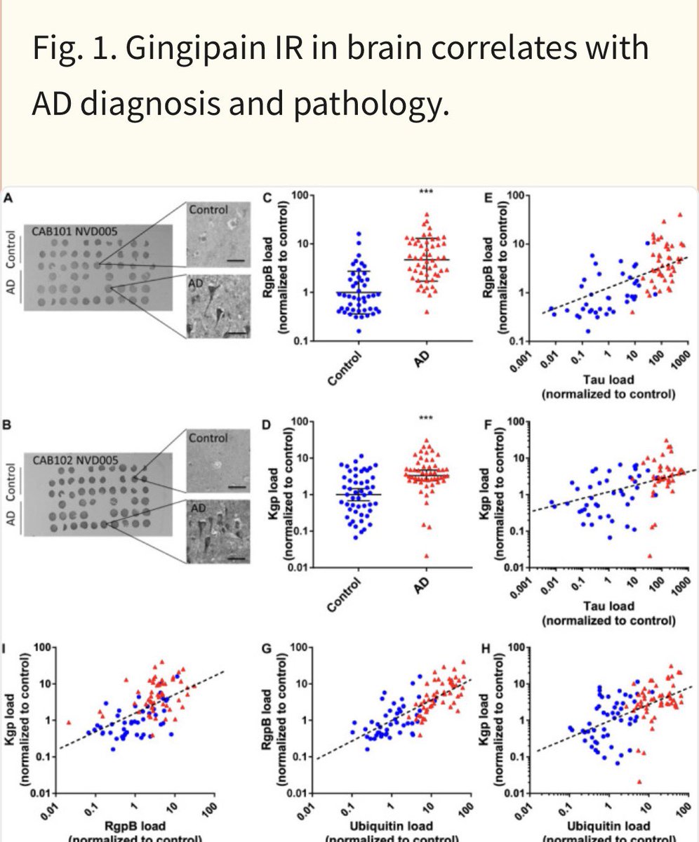 DrGrahamLJ's tweet photo. Seminal paper showing gum disease bacteria and their toxic enzymes play a central role in the development of Alzheimer’s disease.

👇
Porphyromonas gingivalis in Alzheimer’s disease brains: Evidence for disease causation and treatment.

Dominey et al 2019
https://t.co/vmYAG9L54Y https://t.co/9kNOWJ7EXM