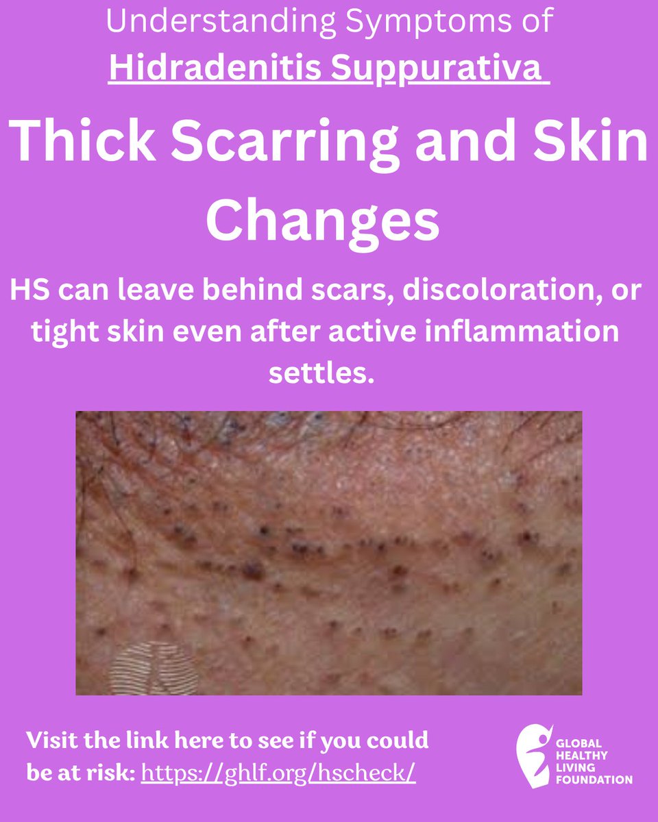 CreakyJoints's tweet photo. HS doesn't just affect you during flares. The scars, discoloration, and skin tightness it leaves behind can last long after the inflammation fades. If your skin has changed in ways you can't explain, it's worth checking. 👉 https://t.co/XeKC2AY57b
#HidradenitisSuppurativa #HSAwareness #ChronicSkinCondition #Scarring #SkinHealth