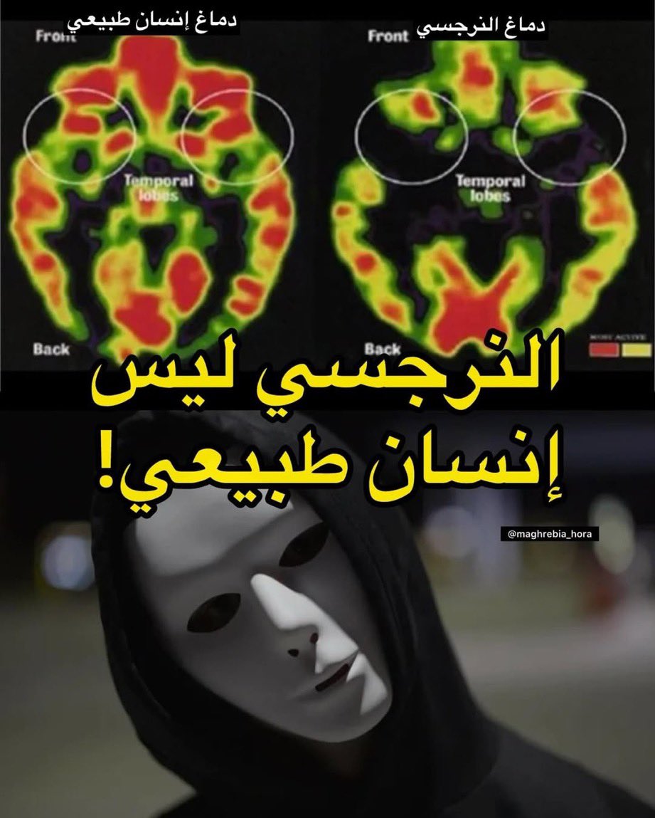 APAM998's tweet photo. @EcoOneE بنفس الوقت يفتقدون للتعاطف، الفرق بين الإنسان النرجسي والإنسان الطبيعي (الجزء المفقود هو المسؤول عن التعاطف لدى الإنسان) https://t.co/4ogCrkDQfr