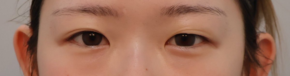 Nbj8xp's tweet photo. リンク美容外科（@kankokuseikei ）で埋没、目頭切開、目つき矯正などの施術を受けました。
担当医師はチョンミンス院長でした👨🏻‍⚕️
丁寧にカウンセリングしていただき自分の目に似合ったデザインを施術してだき日本語が喋れる方がいらっしゃるので日本人でも安心できる雰囲気でした！ https://t.co/4HzxPcBgbK