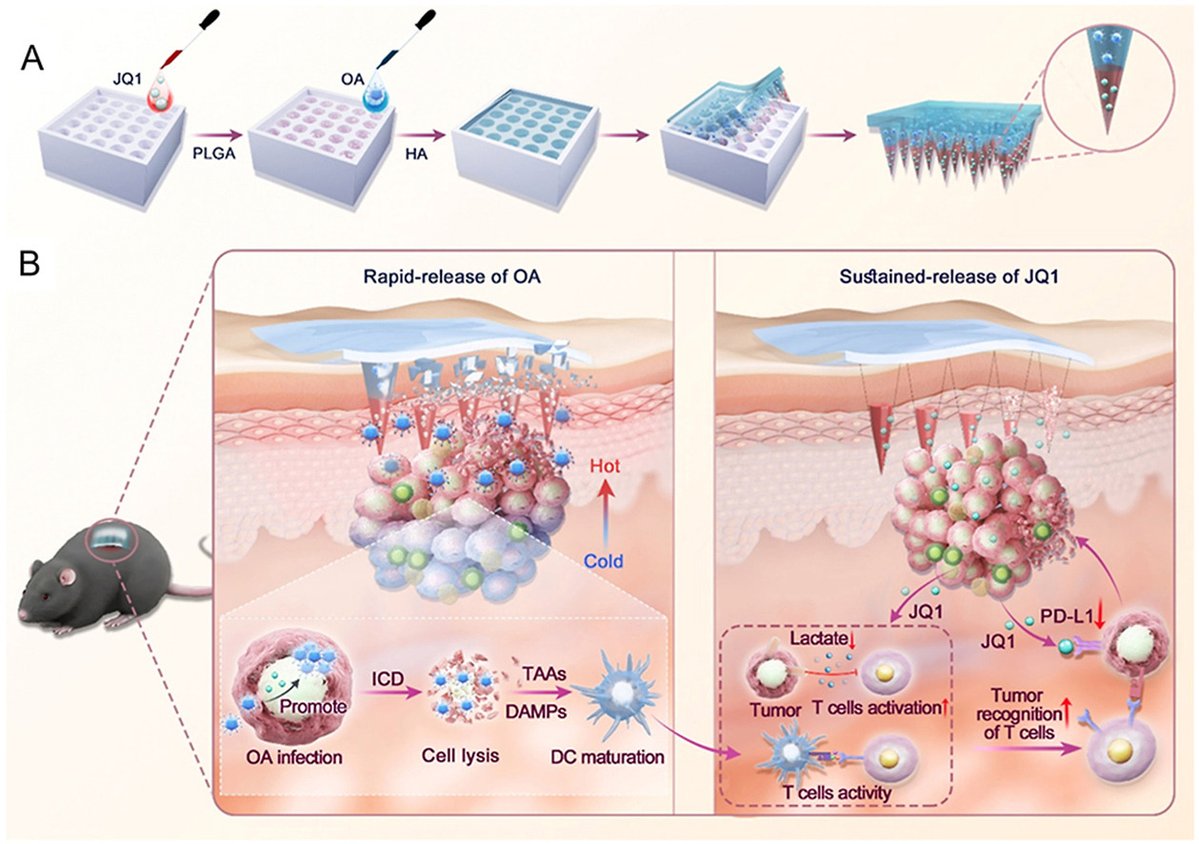 ActaPharmSinB's tweet photo. Article✍️#Multistage responsive #microneedle delivery system loaded #oncolytic #virus for topical therapy of #melanoma. From Dr. Huang @BeijingInstituteofTechnology; @ElsevierConnect; @Sciencedirect.
https://t.co/9S0SFMFcPG. https://t.co/W8J5psLmZE