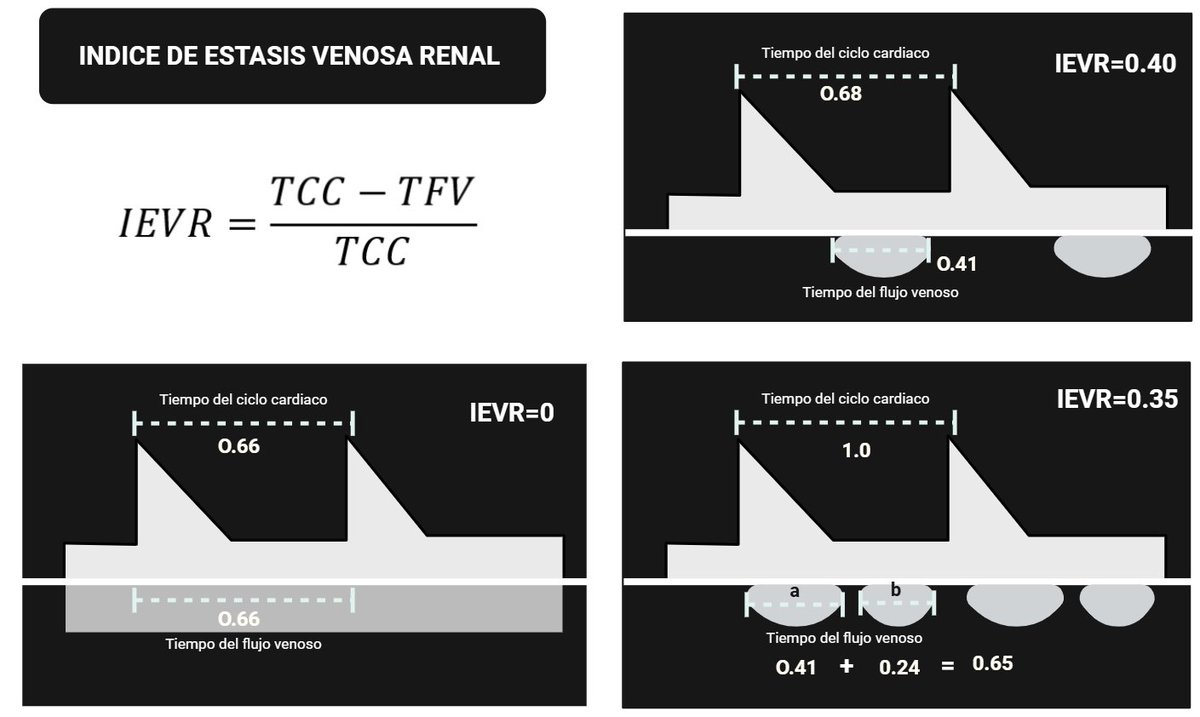 nefropildoras's tweet photo. Qué es el índice de estasis venosa renal (IEVR) y para qué sirve medirlo? 🤔 https://t.co/TwU9lwW6bD