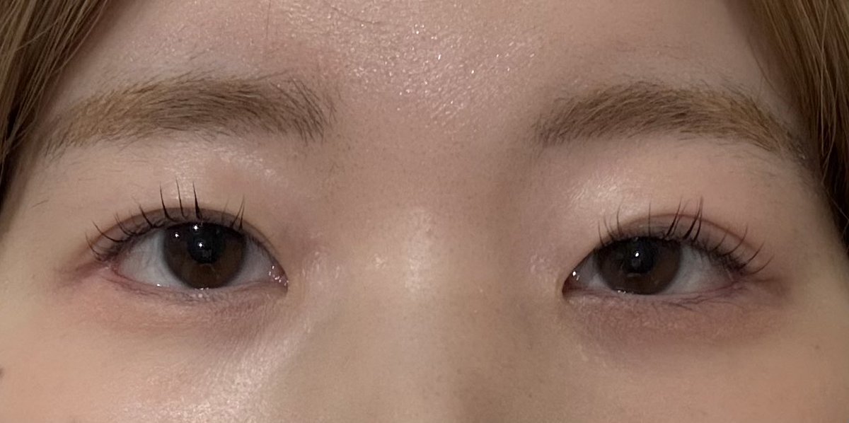 _____naa_oO's tweet photo. アイフィット整形外科(@eyefit_kr)さんで
自然癒着をして1ヶ月経ったので術前と比べてみました🙌

二重幅がはっきり見えるようになったのがホントに嬉しい😭💘💘 まだ腫れは結構あるので、経過見て落ち着くの待ちます^_^ 
腫れ引くの楽しみ～～！ https://t.co/EfpG55KNwJ