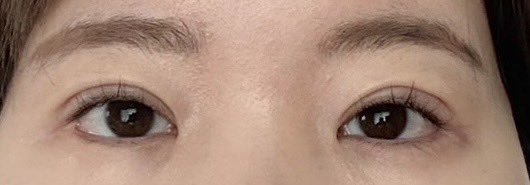 _____naa_oO's tweet photo. アイフィット整形外科(@eyefit_kr)さんで
自然癒着をして1ヶ月経ったので術前と比べてみました🙌

二重幅がはっきり見えるようになったのがホントに嬉しい😭💘💘 まだ腫れは結構あるので、経過見て落ち着くの待ちます^_^ 
腫れ引くの楽しみ～～！ https://t.co/EfpG55KNwJ