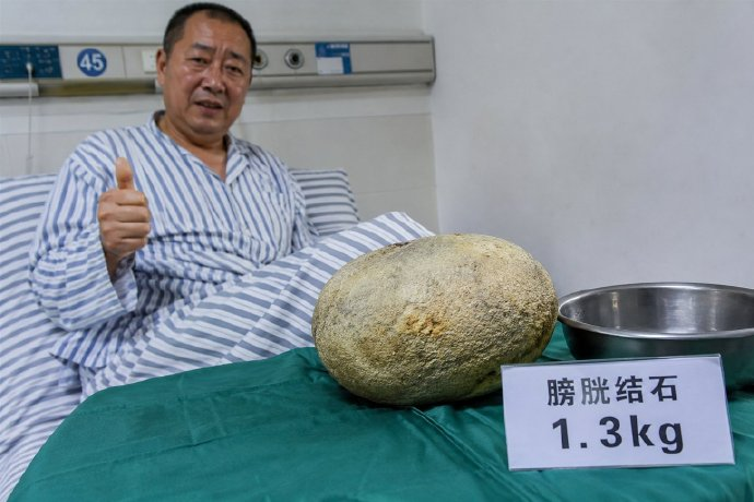 bignene0915's tweet photo. 说这是一个中国的病例，患者56岁，忍受了三年的排尿疼痛，却置之不理……直到医生发现他膀胱里有一颗重达1.3公斤的巨型结石。据报道，这颗结石长10*13厘米，几乎完全占据了他的膀胱。他从此停止了出行，夜不能寐，甚至尝试自行服药以维持工作。 https://t.co/joPrbQF8en