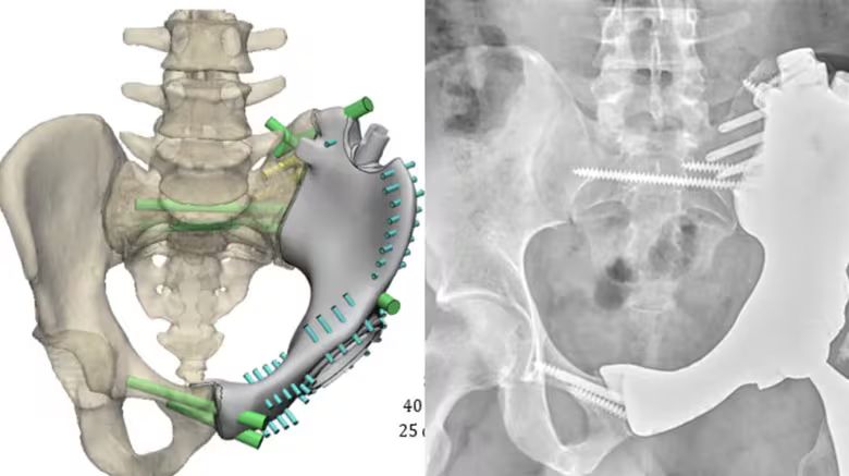 CleClinicMD's tweet photo. A 29-year-old U.S. Army staff sergeant was referred after being diagnosed with chondrosarcoma in the left side of his pelvis.

10 years ago, the only options after resecting the cancer would be to amputate the leg or leave a flail leg. In this case, our sarcoma team opted to replace the removed bone with a custom 3D-printed implant.

More about the case: https://t.co/Ftv0sGwTnU