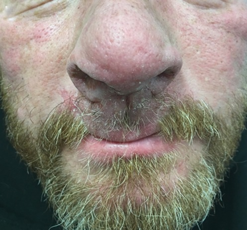 Diagnosis: Cocaine-associated pemphigus vegetans. The chronic ...