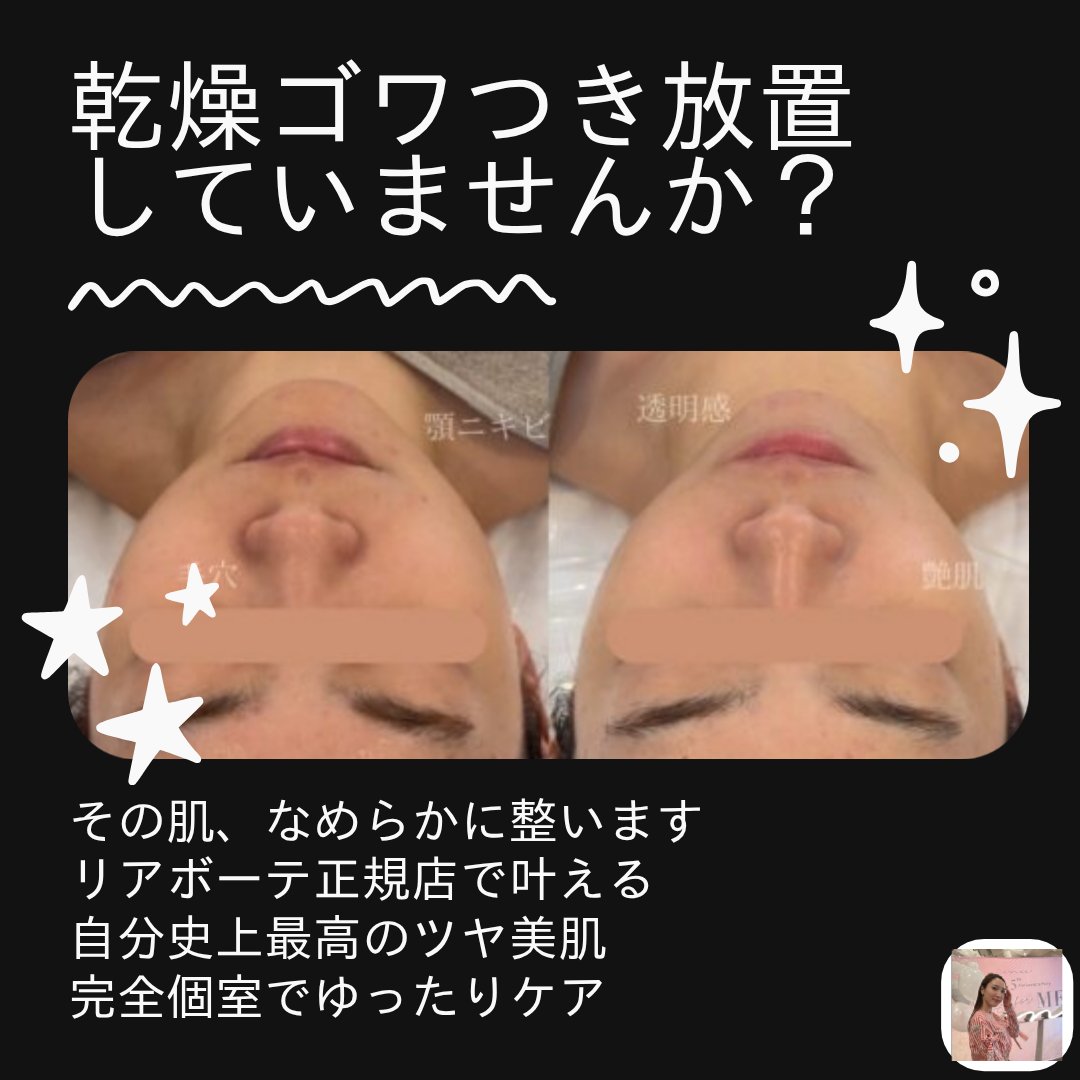 streazzcare's tweet photo. 驚きのビフォーアフター
写真左：乾燥でゴワつきやすく、メイクがのりにくかったお肌。
写真右：施術後はツヤが出て、見た目がなめらかに。
リアボーテ正規×完全個室で肌状態に合わせてケア。https://t.co/EQRCKjqehG
今いちばん気になる肌悩み、何ですか？

#エステ #リアボーテ #ビフォーアフター https://t.co/02IMdMI0c9