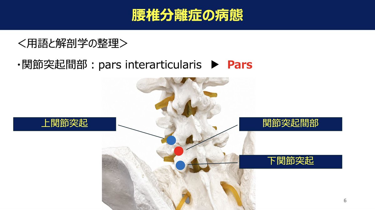 Spo_Lab's tweet photo. 瞬発的な動作は腹横筋の先行収縮が生じている。

腰椎分離症のリハビリテーション
運動療法×体外衝撃波の治療戦略
講師：つくばウェルネス整形外科　山口真吾
日時：2026.6.14 21:00〜オンライン開催
https://t.co/X7mbYl3DTK https://t.co/zGIE12BmYi