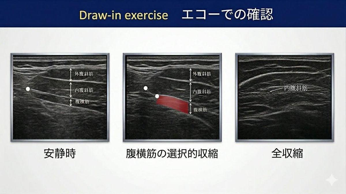 Spo_Lab's tweet photo. 瞬発的な動作は腹横筋の先行収縮が生じている。

腰椎分離症のリハビリテーション
運動療法×体外衝撃波の治療戦略
講師：つくばウェルネス整形外科　山口真吾
日時：2026.6.14 21:00〜オンライン開催
https://t.co/X7mbYl3DTK https://t.co/zGIE12BmYi