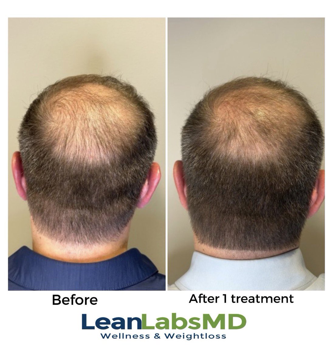 LeanLabsMD's tweet photo. @DrChrisCo @golfmusclemstr This is 6 weeks post a single microneedling TX with GHK-Cu https://t.co/GEB9SYBDr2