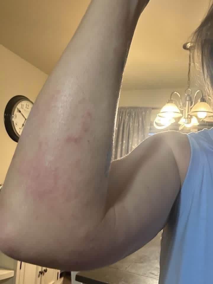 DrkathyDmiller's tweet photo. IVERMECTIN PASTE Testimonial:
A woman in the UK who had been diagnosed with skincancer reported notable clinical improvement after incorporating both @DrkathyDmiller ivermectin paste &amp; oral ivermectin into her treatment regimen.
#Ivermectinpaste 
#basalcellcarcinoma 
#skincancer https://t.co/KD3fRaSgAG