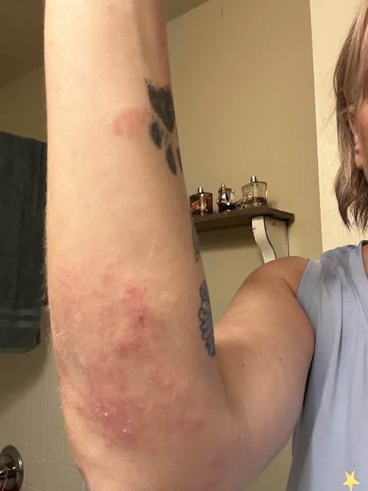 DrkathyDmiller's tweet photo. IVERMECTIN PASTE Testimonial:
A woman in the UK who had been diagnosed with skincancer reported notable clinical improvement after incorporating both @DrkathyDmiller ivermectin paste &amp; oral ivermectin into her treatment regimen.
#Ivermectinpaste 
#basalcellcarcinoma 
#skincancer https://t.co/KD3fRaSgAG