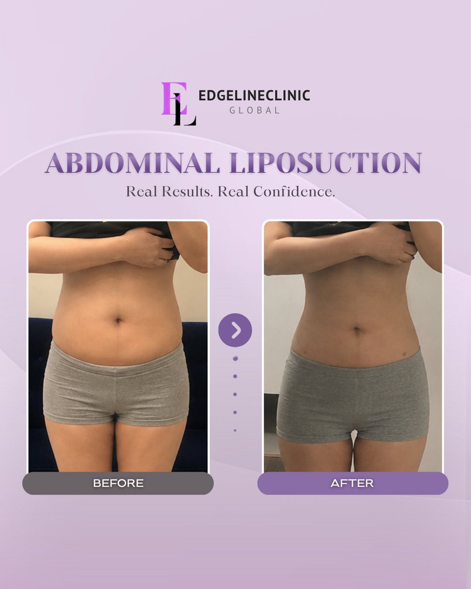 edgeline_global's tweet photo. Abdominal Liposuction Before and After ✨

📍Gangnam, Seoul Korea

📩 Book your consultation today.
WhatsApp: +82 10 3970 2135
Email: edgelinegangnam@naver.com
WeChat: edgeline_gangnam
LINE: @343tnxkn

#abdominalliposuction #korealiposuction #koreaplasticsurgery #beforeandafter https://t.co/XqWhc5HLTK