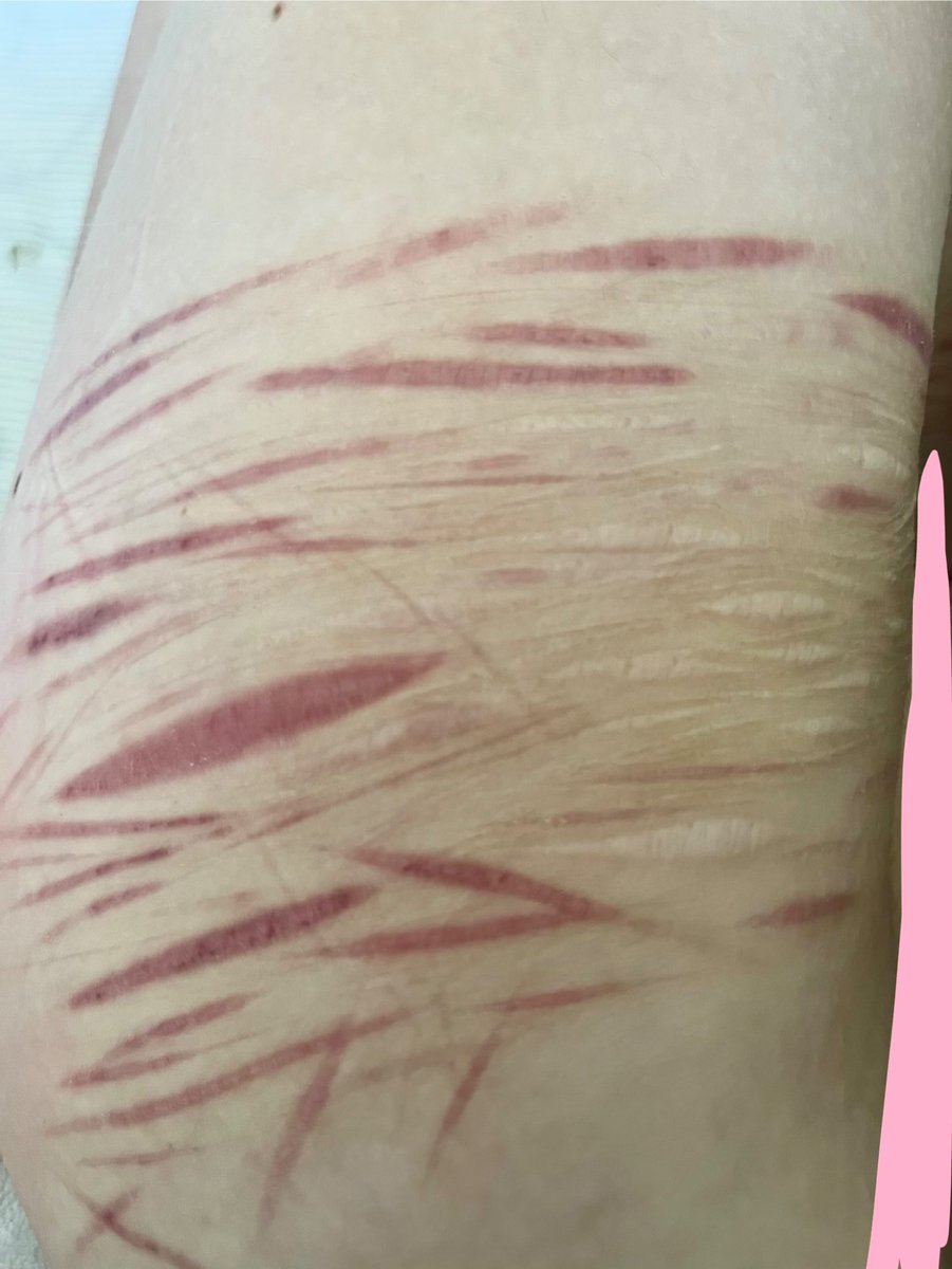 SpraksAhoy's tweet photo. Scar check! ( ◠‿◠ ) ♡
Left thigh vs Right thigh
(my messy cutters wya?) https://t.co/nL4Xazc39J
