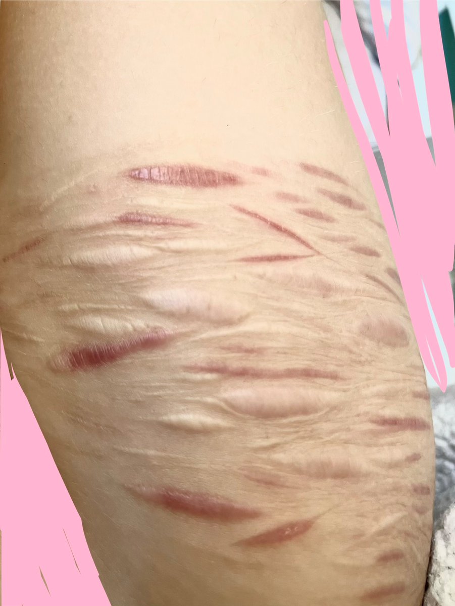 SpraksAhoy's tweet photo. Scar check! ( ◠‿◠ ) ♡
Left thigh vs Right thigh
(my messy cutters wya?) https://t.co/nL4Xazc39J