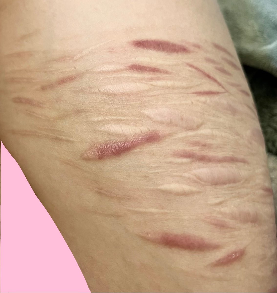 SpraksAhoy's tweet photo. Scar check! ( ◠‿◠ ) ♡
Left thigh vs Right thigh
(my messy cutters wya?) https://t.co/nL4Xazc39J