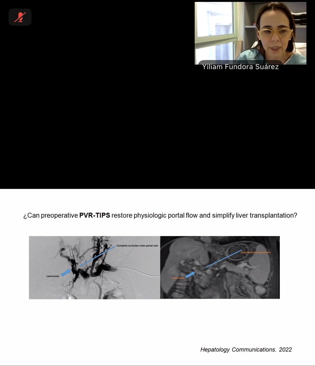 CEIHPBA's tweet photo. One of the key messages from our recent CE-IHPBA webinar:

Pre-transplant portal vein recanalization and PVR-TIPS may simplify transplantation by restoring physiological portal inflow in selected patients. https://t.co/49Mcw2BDop