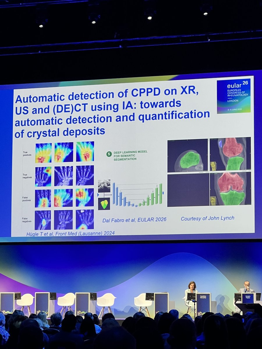 eular_ero's tweet photo. #EULAR2026 highlights in #CPPD imaging:
🔹 US quantification is becoming feasible with emerging OMERACT-based scoring systems.
🔹 AI-driven detection on XR, US, and DECT is moving from concept to reality.
🔹 Shifting from simple detection toward quantification of crystal burden. https://t.co/xKvU9jz4dk