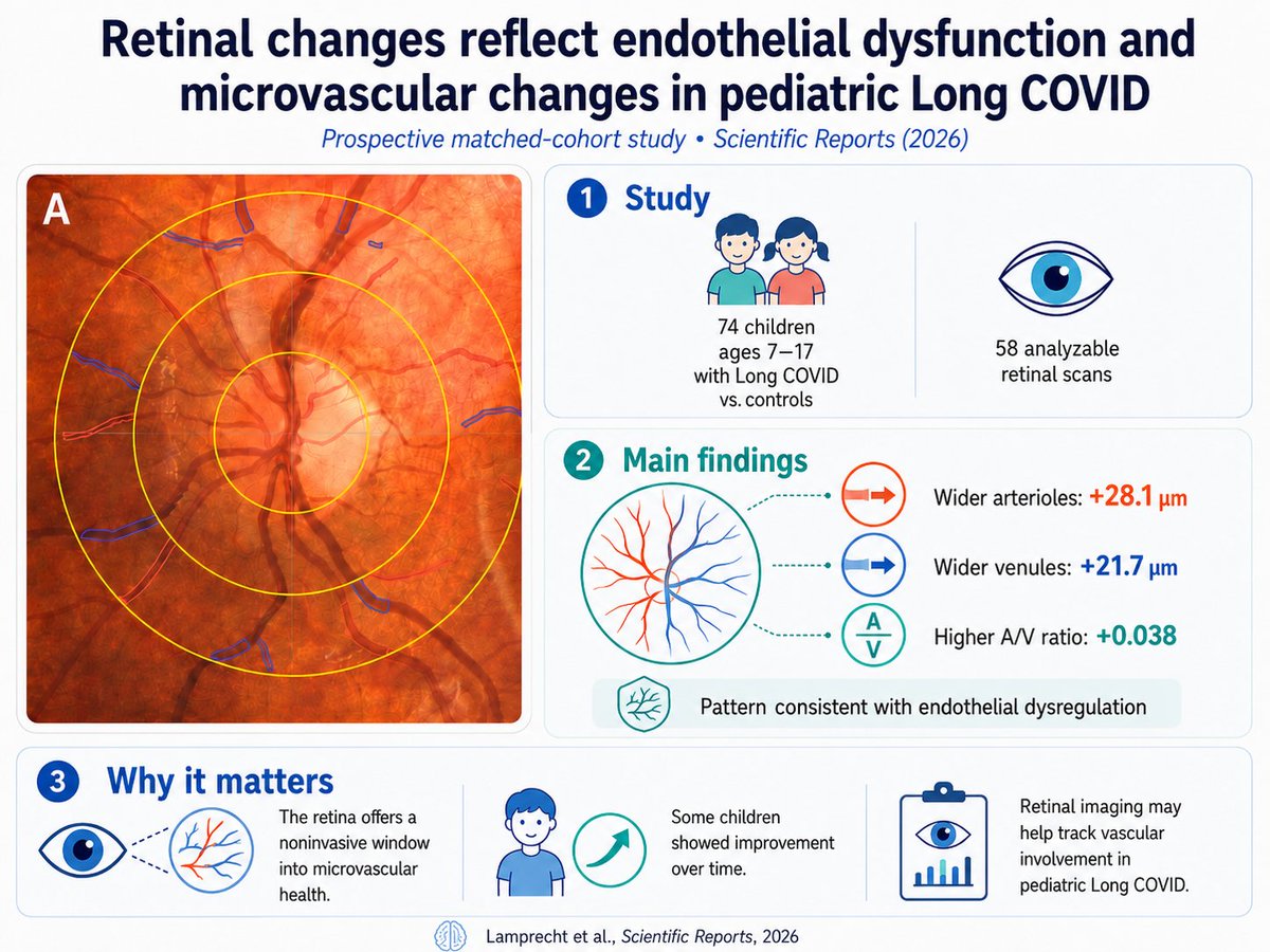 CatchTheBaby's tweet photo. Children with Long COVID had measurable retinal microvascular changes. https://t.co/eIElYHievL

In 74 kids ages 7–17, scans found wider arterioles, wider venules, and a higher A/V ratio, consistent with endothelial dysfunction.

The eye may help track pediatric Long COVID. https://t.co/oXjYqlt5cj