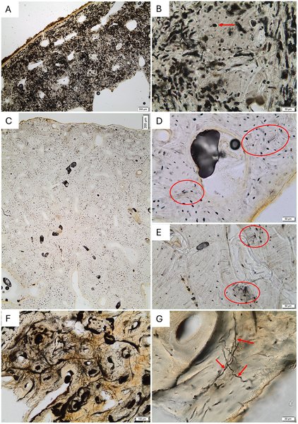 wirthstef's tweet photo. #Bioerosion can be a key process in the #decomposition of organic matter. In general, bioerosion describes the #breakdown of #solid #substances by #livingorganisms. This can include purely inorganic material, such as stone. In the case of the breakdown of solid components associated with #animaltissue, the term decomposition may also be used. The process often remains insufficiently studied, as understanding such complex processes requires specific investigations within specific contexts. Generalizations are frequently difficult to make.

Nevertheless, D. Kaptan et al. (2026) were able to draw broader #conclusions regarding a phenomenon of great importance to archaeologists: the factors determining the state of #preservation of (human) #bones. Bones may be preserved in remarkably good condition or, conversely, may have survived the passage of time very poorly. According to the researchers, the location and conditions of the body's burial play a crucial role in this regard. By analyzing museum specimens of varying ages and origins, they determined that bones #buried inside #buildings, characterized by high #microbialdiversity within their #microbiome, exhibited better preservation. A comparison of samples from buildings versus those from conventional #cemeteries revealed additionally differences in the #bacterial #speciescomposition involved; findings that were derived from #metagenomic #analyses. Consequently, #Streptomyces #bacteria appear to play a significant role in the accelerated decomposition of bones following #soilburial.
© this text Stefan F. Wirth

Reference
D. Kaptan et al. (2026):
https://t.co/x3hZ14spZ4

#Figure:
Examples of bioerosion in the studied #assemblage.
(A) Extensive bioerosion in #sample S10294.17b; no original microstructure is visible. (B) Detail from the same sample as in (A), showing characteristic destructive foci and small areas of well-preserved bone despite intense microbial attack. The arrow indicates a focal destruction surrounded by preserved bone. (C) Well-preserved sample (S14393.104) with no focal destruction observed. (D) Detail of the same sample, showing possible early-stage bioerosion (red ellipses), and (E) the same possible onset of biodegradation seen in sample S14393.80. (F–G) Wedl-type tunneling observed in the mid-cortex of sample S14604.10 at two magnifications. Arrows in (G) indicate individual tunnels. Authors D. Kaptan et al. (2026), licensed under https://t.co/etQ1SDmkZS
